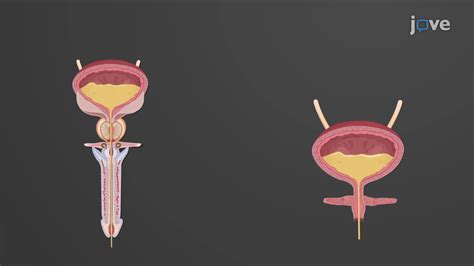 Esquema mostrando la uretra distal y proximal en hombres y mujeres, señalando la localización típica del cáncer
