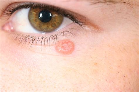 Foto: Ejemplo de carcinoma basocelular en el párpado