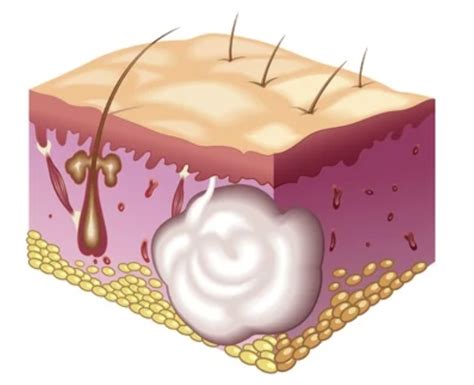 Foto: Apariencia de un quiste epidermoide con poro central