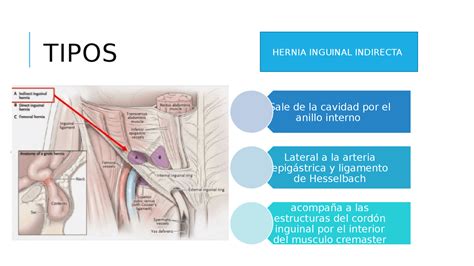 Esquema anatómico de una hernia inguinal