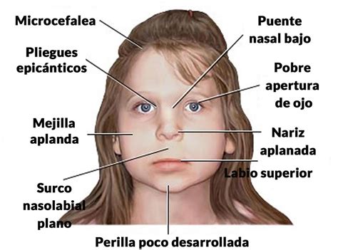 fotografía de un niño con características faciales del síndrome de Mowat-Wilson