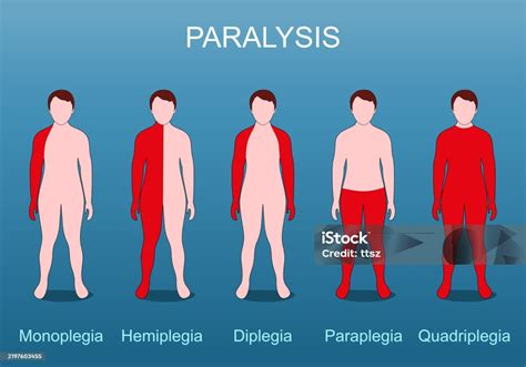 infografía sobre tipos de parálisis según la extensión (monoplejia, hemiplejia, paraplejia, tetraplejia)