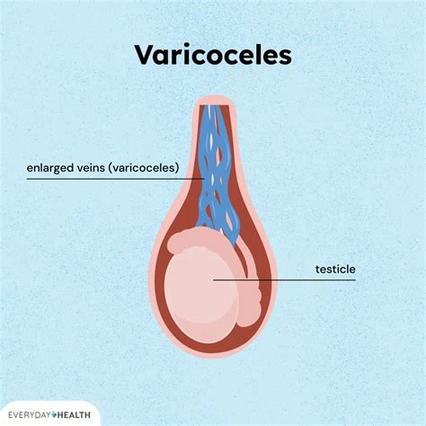 Esquema de un varicocele