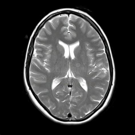 Imagen de resonancia magnética cerebral mostrando hidrocefalia