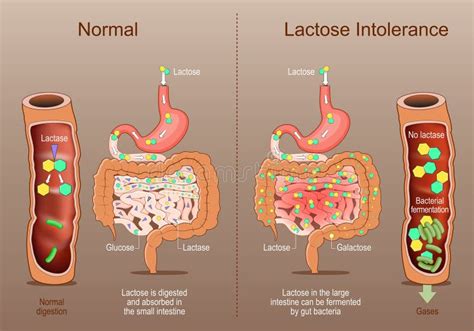 infografía: proceso de digestión de la lactosa en intestino delgado y qué ocurre en la intolerancia