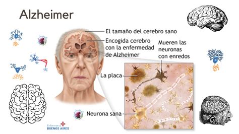 Esquema de las afectaciones cerebrales en la enfermedad de Alzheimer (placas y ovillos)