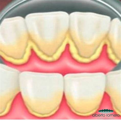 Esquema de la acumulación de placa y sarro en los dientes y encías