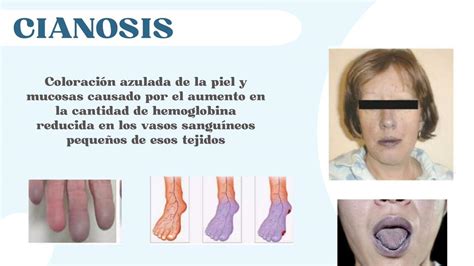 Infografía: Causas comunes de cianosis en adultos mayores