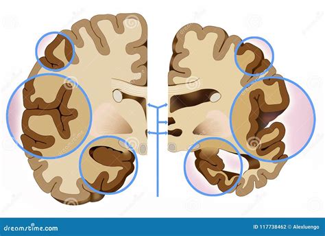 Diagrama comparativo entre un cerebro sano y un cerebro afectado por Alzheimer