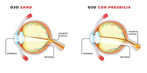 Esquema: ojo con presbicia y corrección