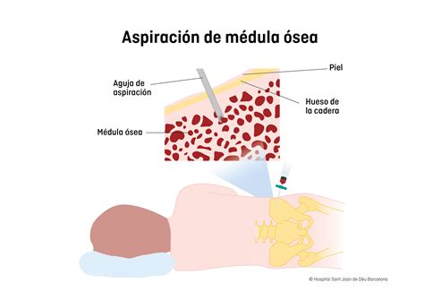 Fotografía de un aspirado de médula ósea mostrando células plasmáticas inmaduras o disgranulopoyesis