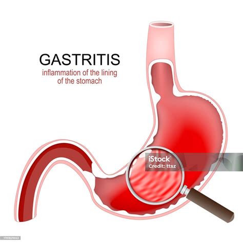 Ilustración de un estómago inflamado (gastritis)