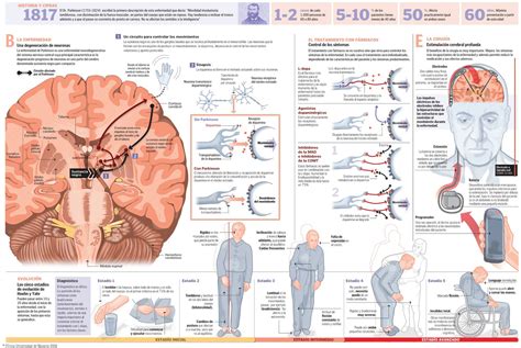 Esquema de la progresión de la enfermedad de Parkinson y la relación con la pérdida neuronal