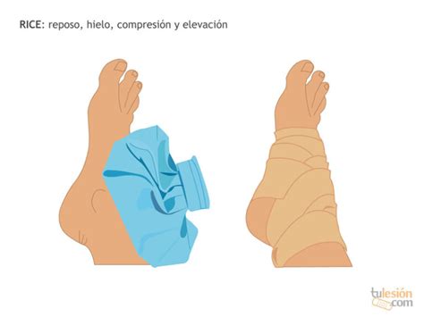 Ilustración del método RICE (Reposo, Hielo, Compresión, Elevación)