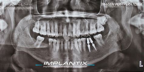Radiografía de implantes dentales en zona posterior