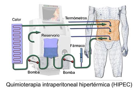Infografía: cómo funciona la quimioterapia intraperitoneal hipertérmica (HIPEC)