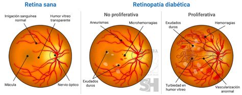 Imagen de un fondo de ojo con signos de retinopatía diabética