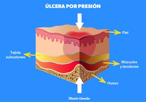 Esquema de las causas de las úlceras por presión en la piel (presión, fricción, cizallamiento)