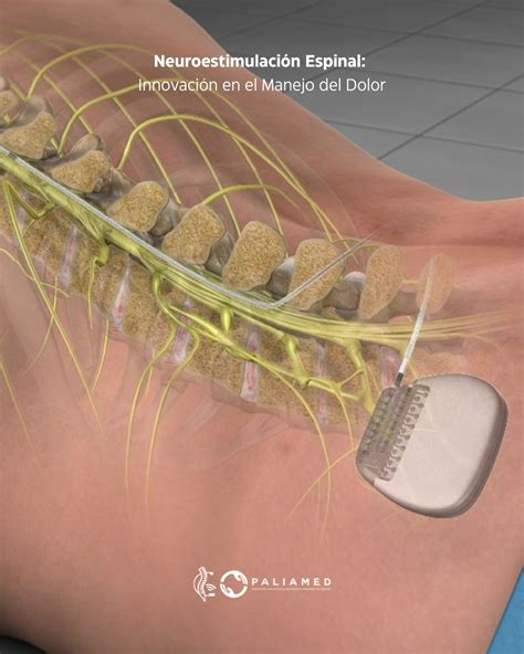 Gráfico con los beneficios de la neuroestimulación en pacientes con demencia