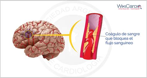 Esquema anatómico que diferencia el accidente cerebrovascular isquémico (bloqueo) del hemorrágico (sangrado).