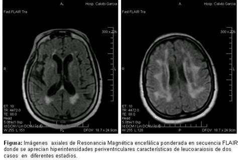 Ejemplo de resonancia magnética cerebral mostrando lesiones de leucoaraiosis en la sustancia blanca