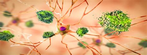 Esquema: formación de placas amiloides en el cerebro
