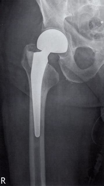 Radiografía de una artroplastia de cadera
