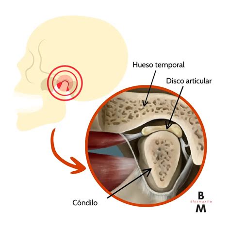 Esquema anatómico de la articulación temporomandibular y sus componentes, incluyendo el disco articular.