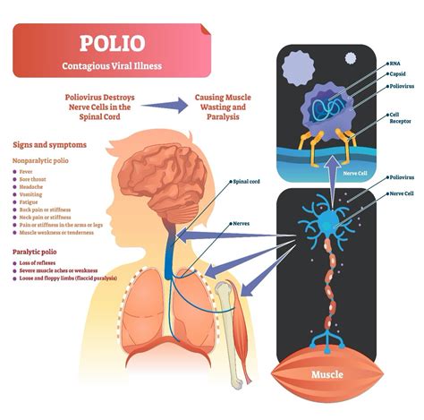 Infografía: Mecanismo de acción del poliovirus y desarrollo del Síndrome Post-Polio