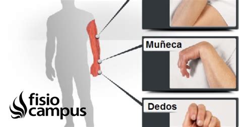 Gráfico de distribución de espasticidad por articulación