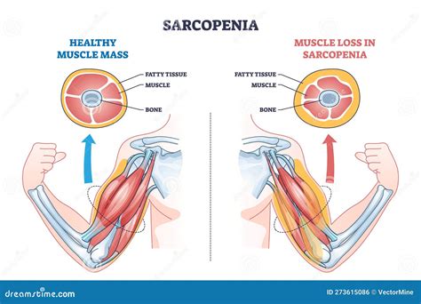 Diagrama que muestra la pérdida de masa muscular (sarcopenia) y sus efectos en la movilidad y el equilibrio de los adultos mayores.