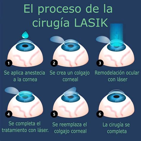 Esquema visual o fotografía de una cirugía LASIK o de ojos con buena visión