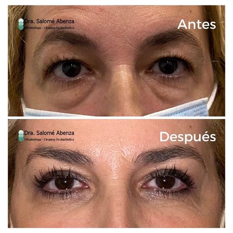 Imagen de antes y después de una blefaroplastia