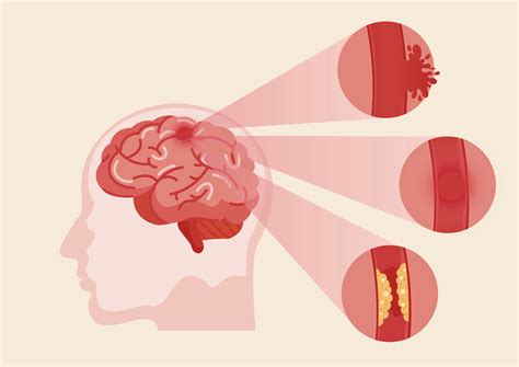 Gráfico de las etapas de recuperación de un accidente cerebrovascular