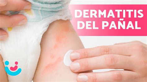 Foto: Dermatitis micótica del pañal con pápulas satélite en piel envejecida