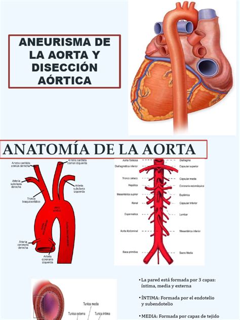 Diagrama de la aorta con un aneurisma y una disección