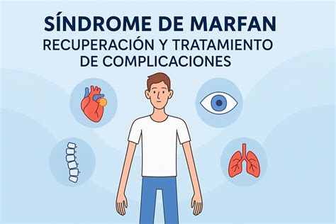 Infografía mostrando las características esqueléticas del Síndrome de Marfan (ej. aracnodactilia, pectus excavatum, escoliosis)