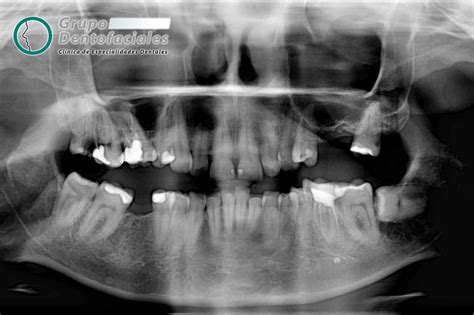 radiografía dental panorámica mostrando muelas del juicio impactadas en un adulto mayor