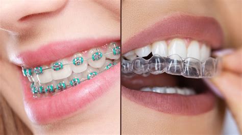 Foto de una persona mayor sonriendo con brackets o alineadores transparentes
