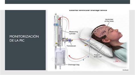 Infografía sobre la monitorización neurológica en UCI, mostrando equipos de presión intracraneana y electroencefalograma