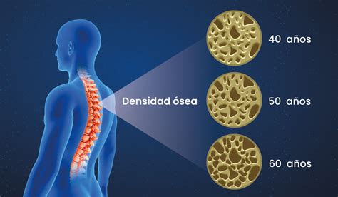 Infografía sobre la pérdida de densidad ósea con la edad y sus efectos en la columna vertebral