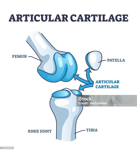 Diagrama mostrando la degeneración del cartílago en una articulación