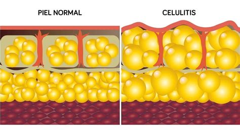 Foto de cerca de piel con celulitis en muslo