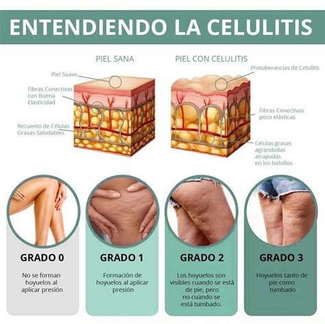 Infografía de los diferentes tipos de celulitis (blanda, dura, edematosa)