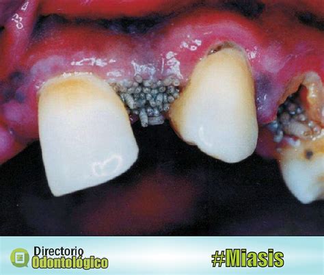 Ilustración médica de miasis oral o bucal