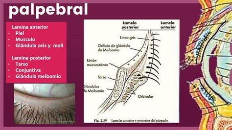 Diagrama mostrando la anatomía del párpado y la ubicación de las glándulas de Meibomio con un chalazión.