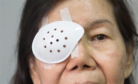 Foto de un ojo con un parche protector después de una cirugía menor.