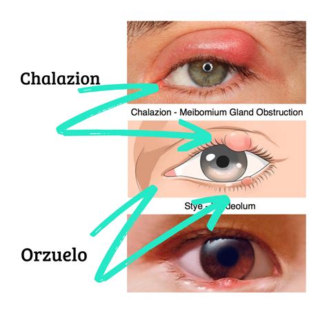 Ilustración de un ojo con un orzuelo o chalazión en el párpado.