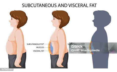 Ilustración de grasa visceral vs. subcutánea