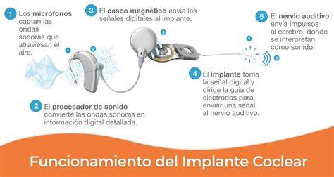 Infografía mostrando diferentes tipos de audífonos e implantes cocleares